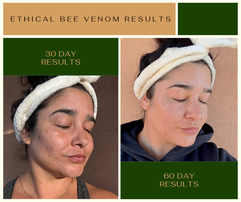 Woman showing 30 and 60 day before and after bee venom skincare results by the alambique